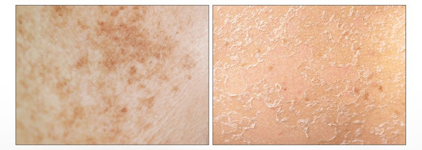 Medipeel+ / Melanon X Dark Spot Cream Patch — Parche Corrector de Manchas - Miroi Store